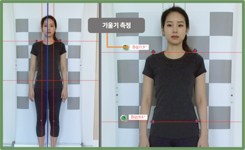 거북목 일자목 디스크로 진행되기전에 자세교정운동과 추나요법으로 체형교정하세요!!
