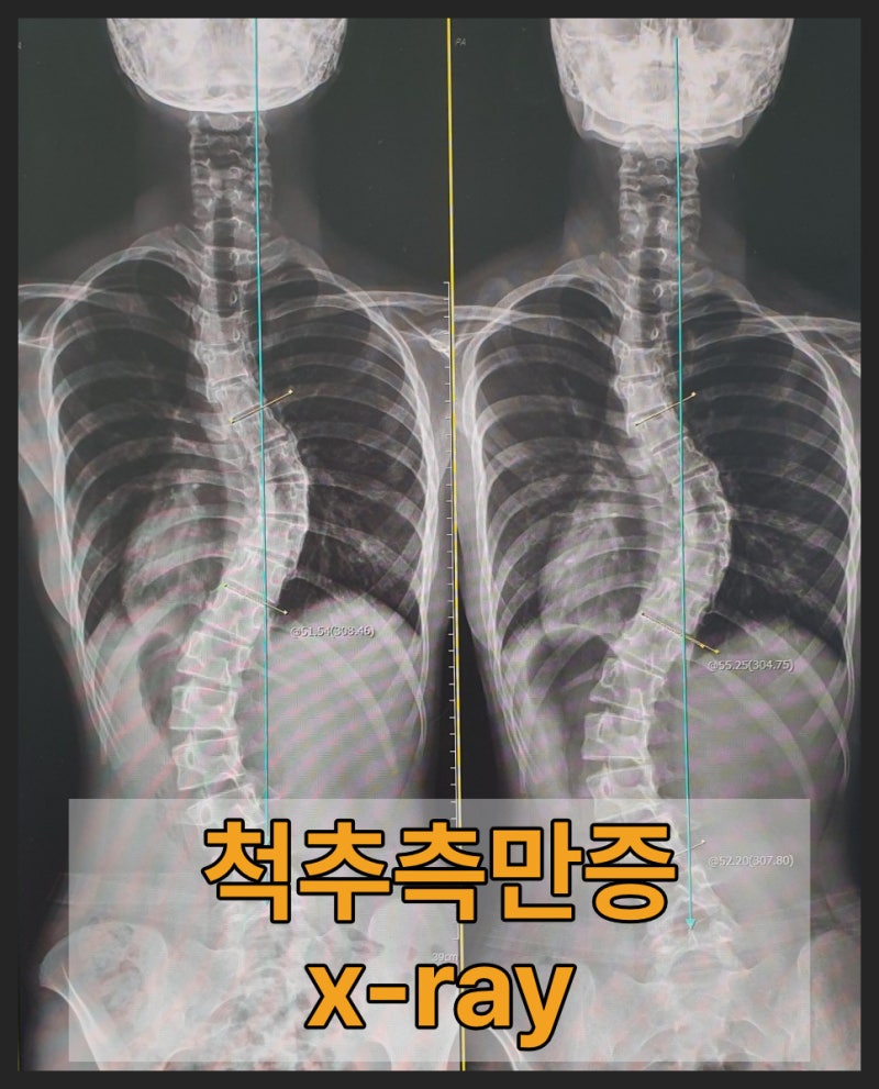 성장기 청소년 자세교정과 슈로스운동·추나요법