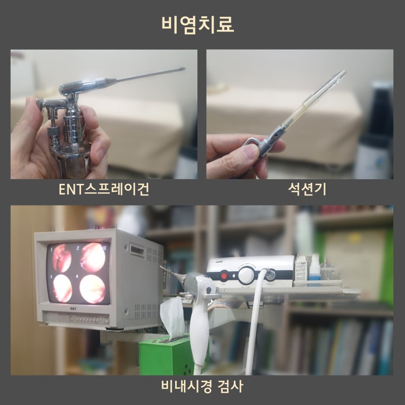 여름철 알레르기비염,콧물과 재채기가 계속된다면？