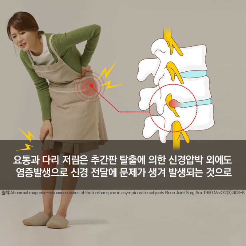 추간판탈출증으로 허리통증 다리저림 증상이 있으시면 무조건 수술하지마시고