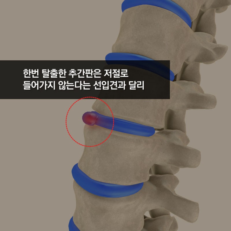 추간판탈출증으로 허리통증 다리저림 증상이 있으시면 무조건 수술하지마시고