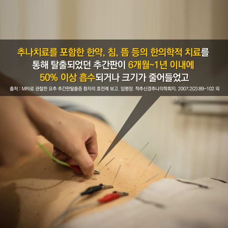 추간판탈출증으로 허리통증 다리저림 증상이 있으시면 무조건 수술하지마시고