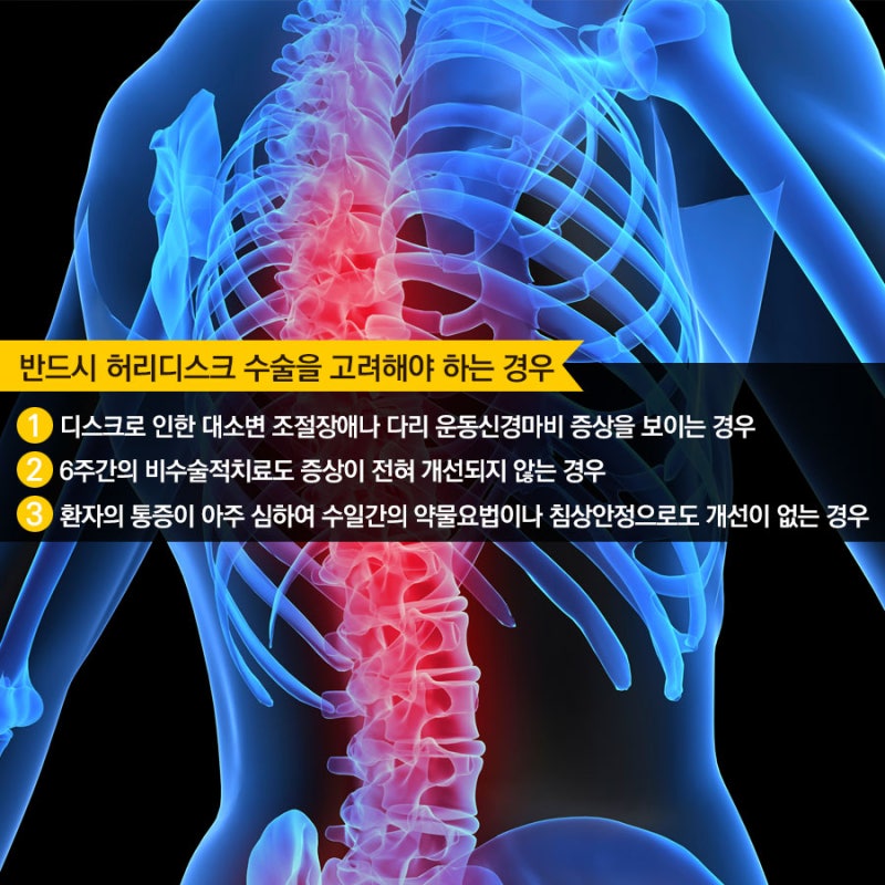 추간판탈출증으로 허리통증 다리저림 증상이 있으시면 무조건 수술하지마시고