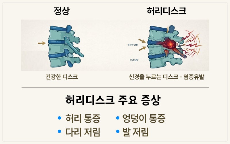 허리통증·다리저림,비수술 치료는 어떻게 할까요